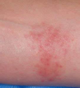 allergie biocide