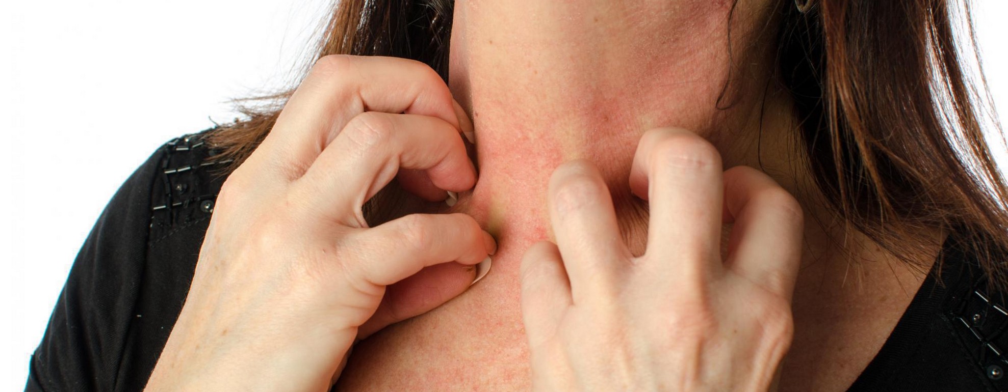 lait d anesse pour le psoriasis