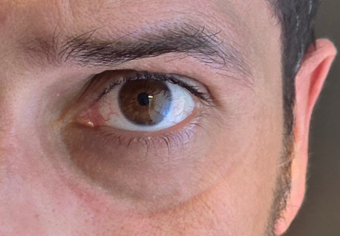 Marque autour de l'oeil dix minutes apres le test des lunettes