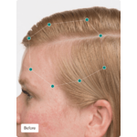 Nutrafol-Womens-Balance-Before
