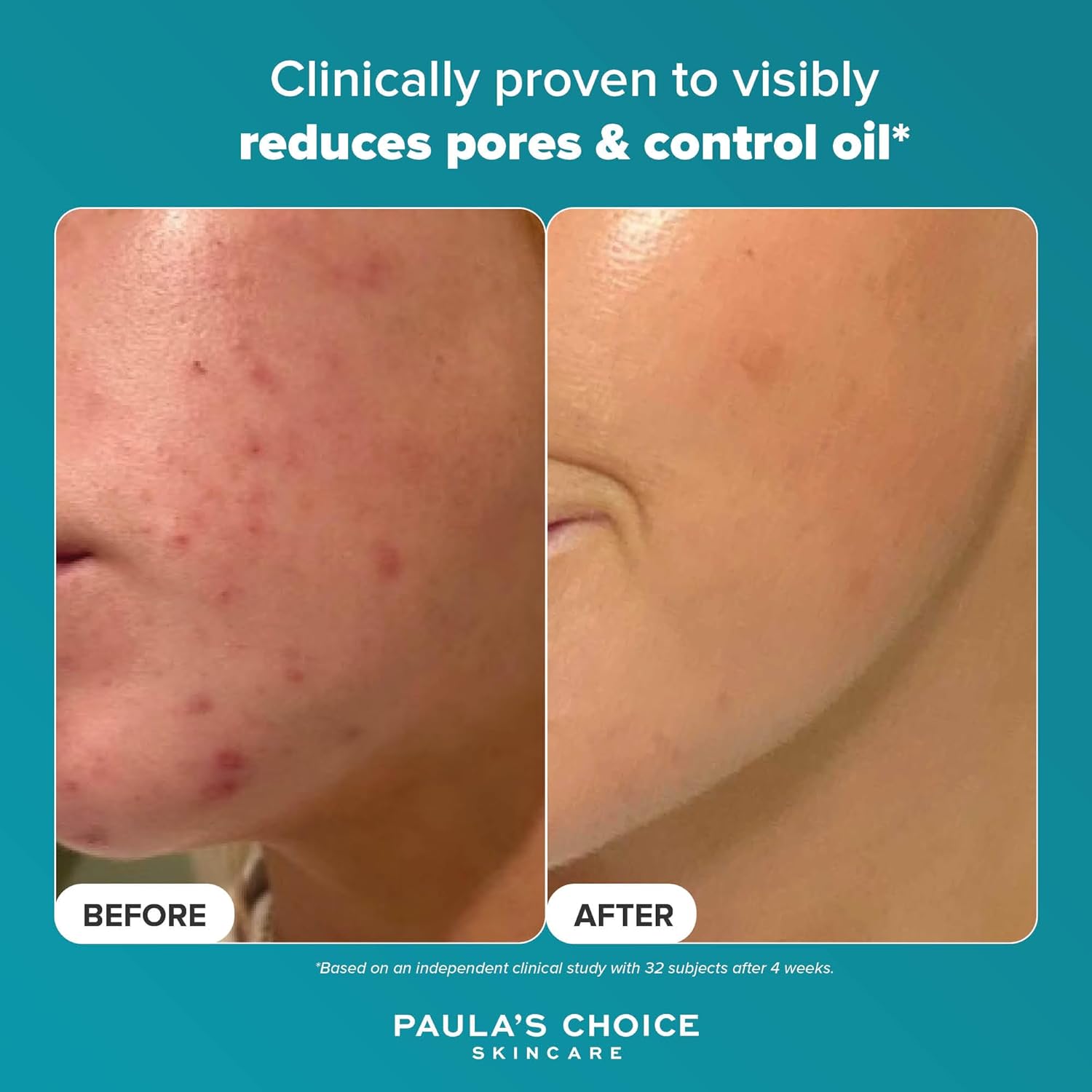 PAULAS CHOICE LIQUID EXFOLIANT 5