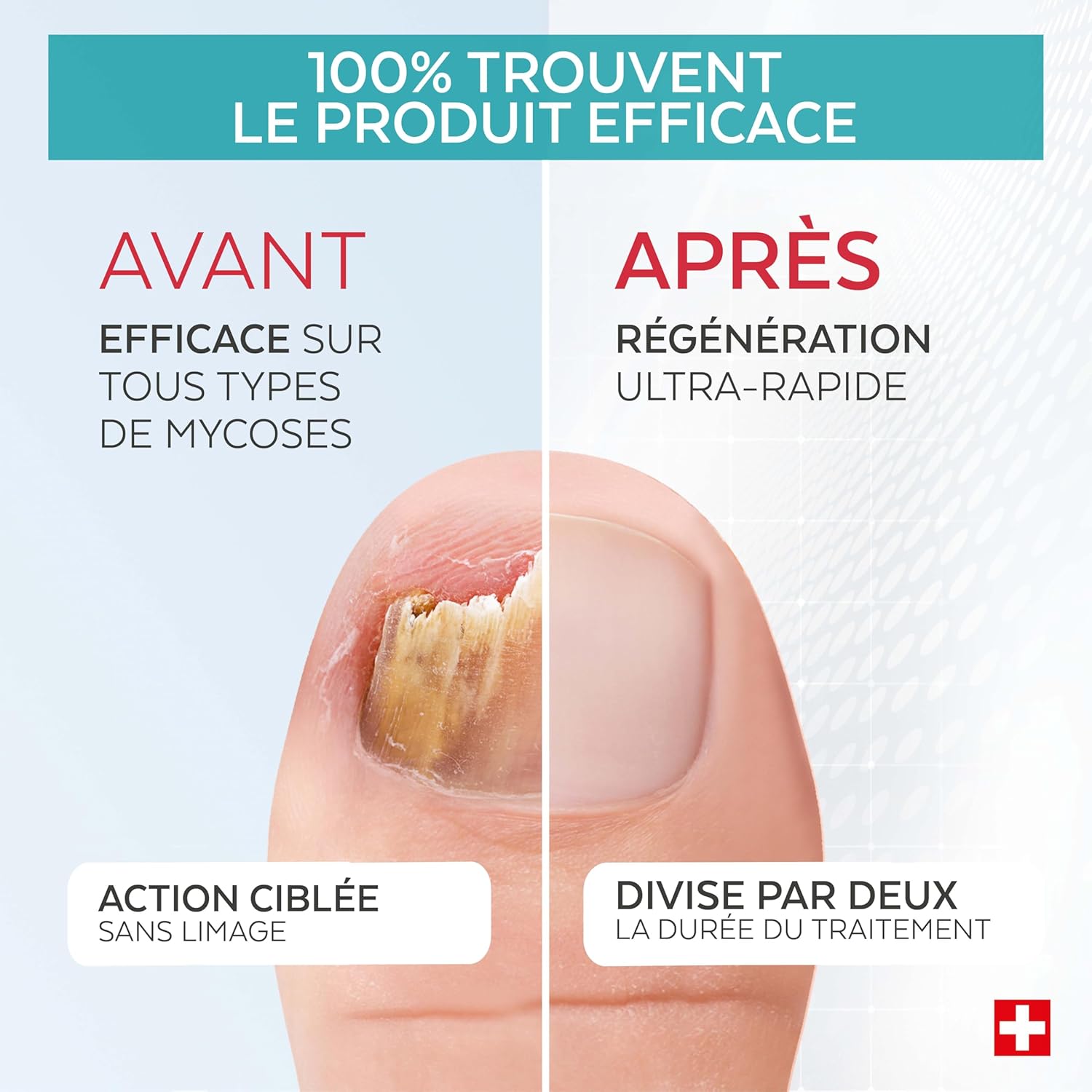 Traitement mycose ongle 3