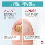 Traitement mycose ongle 3