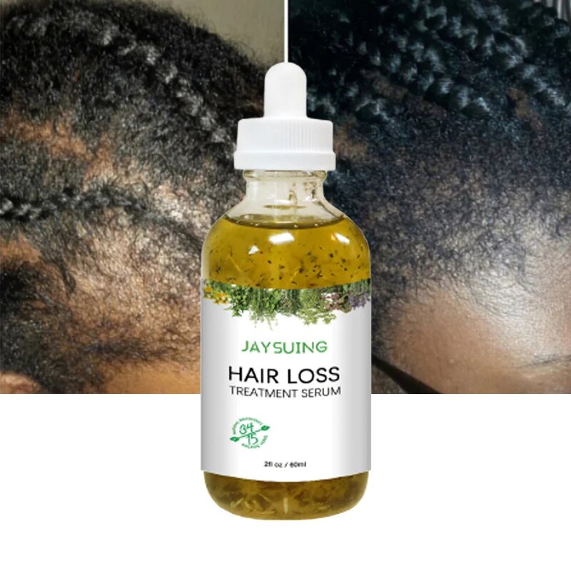 Sérum pour la croissance rapide des cheveux, traitement à l\'huile essentielle, prévention de la perte de cheveux, traction, alopécie, soins de repousse, beauté, santé, nouveau