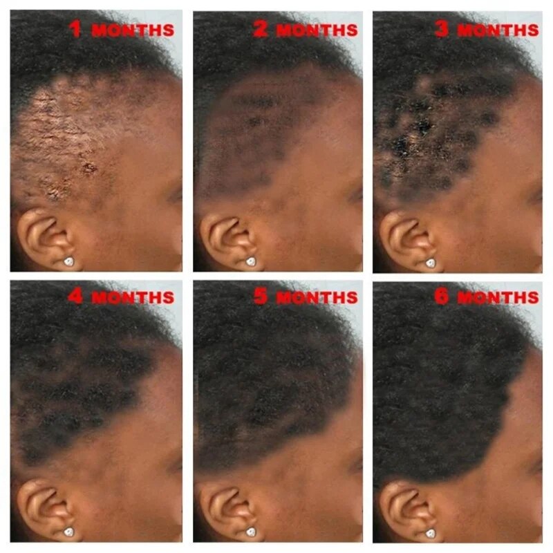 S-rum-pour-la-croissance-rapide-des-cheveux-traitement-l-huile-essentielle-pr-vention-de-la