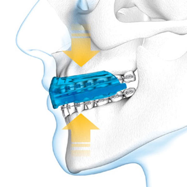 1458braces-3