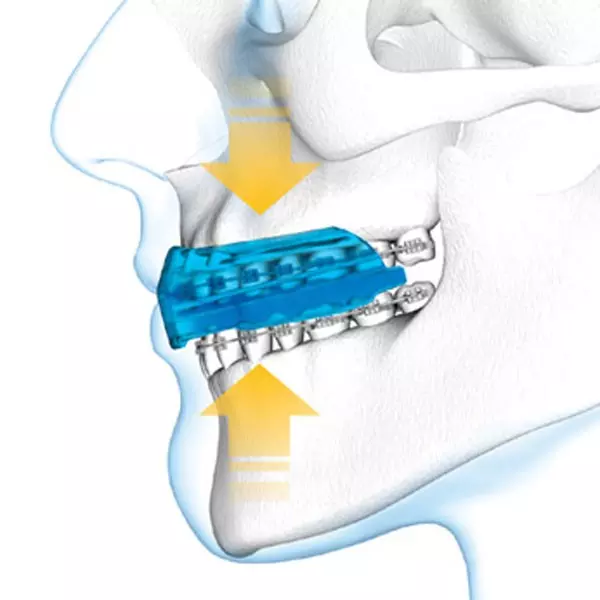1458braces-3