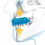 1458braces-3