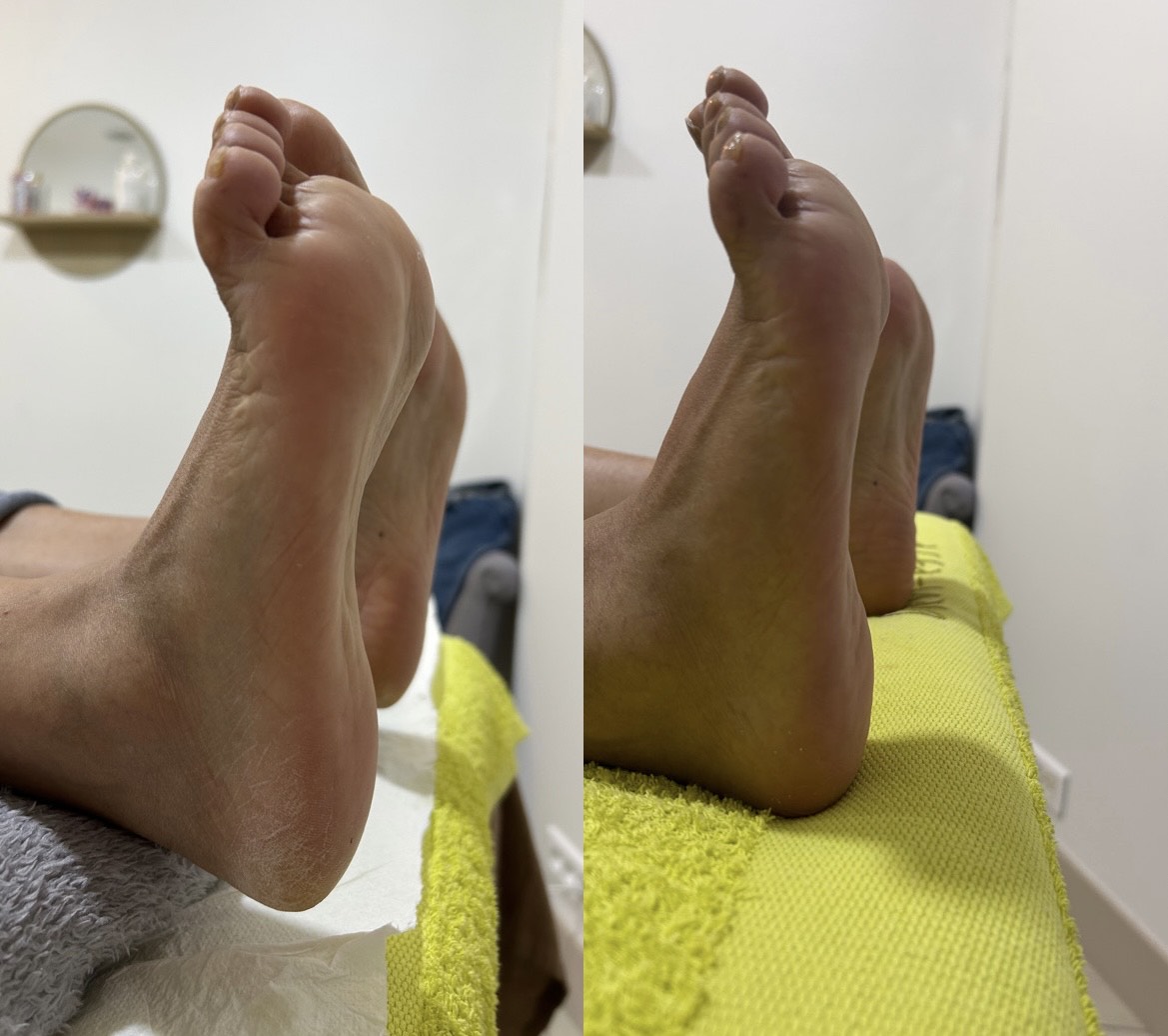 avant apres yumi feet