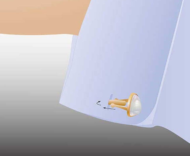 5 inserer le bouton de manchette et le fixer