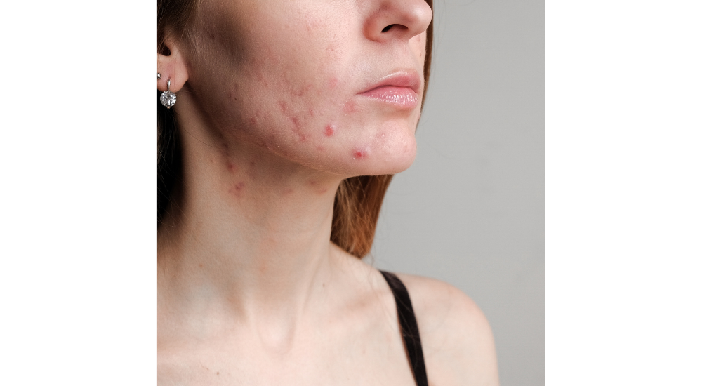 acne