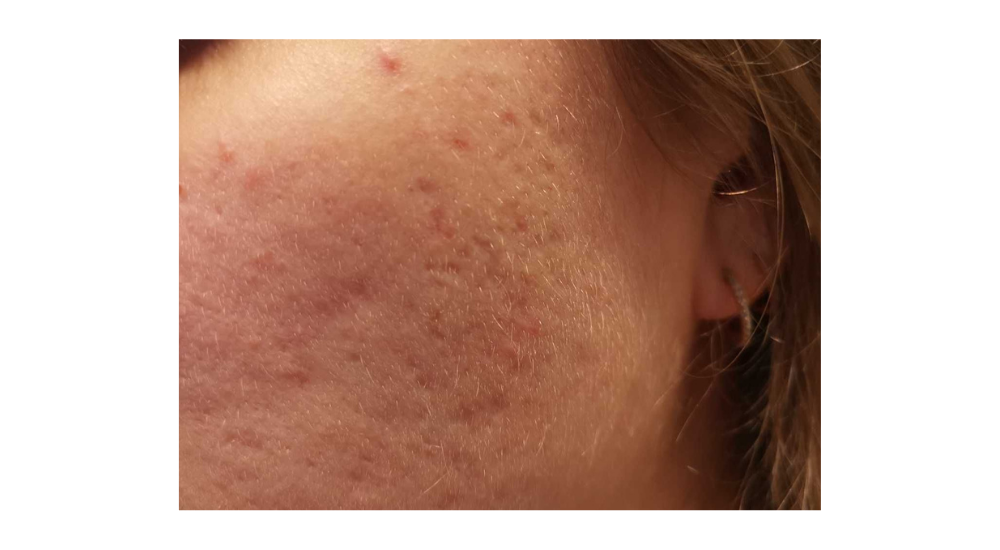 cicatrices d acne