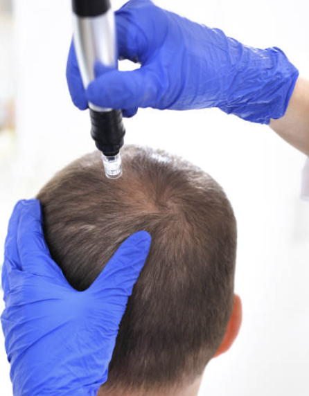 Microneedling