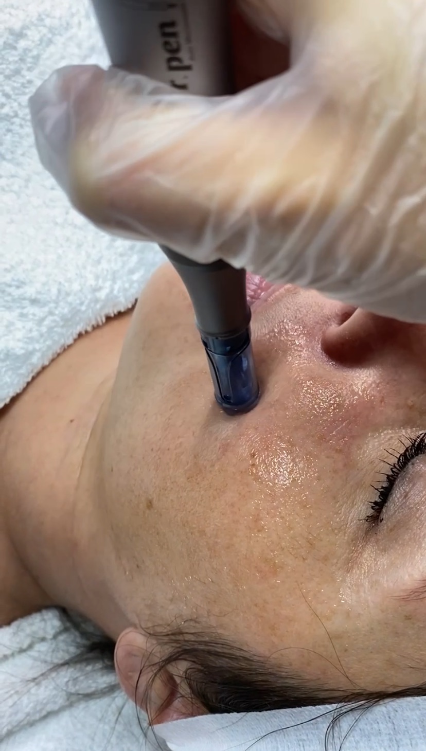 nano needling