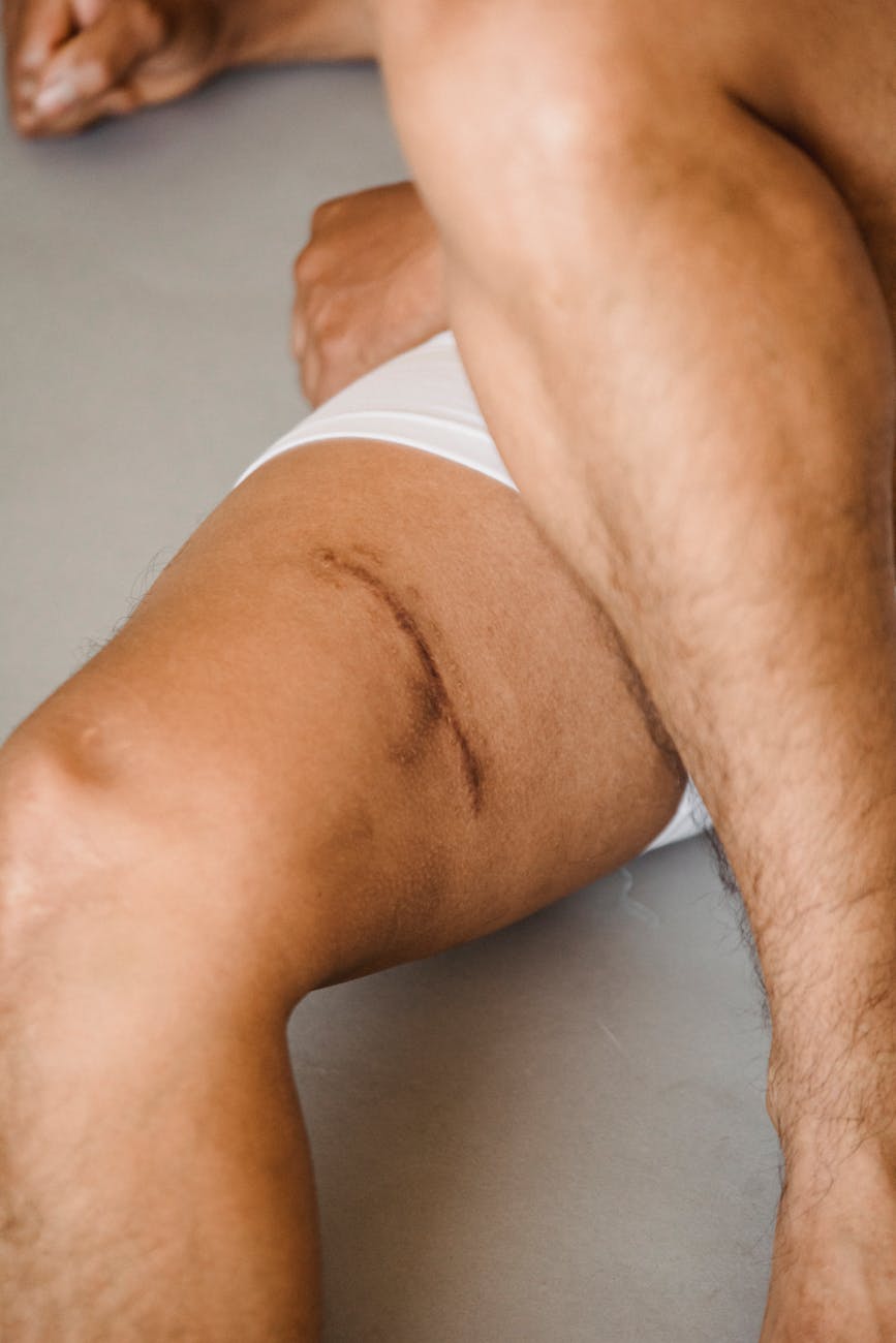 crop man en slip avec cicatrice sur la cuisse
