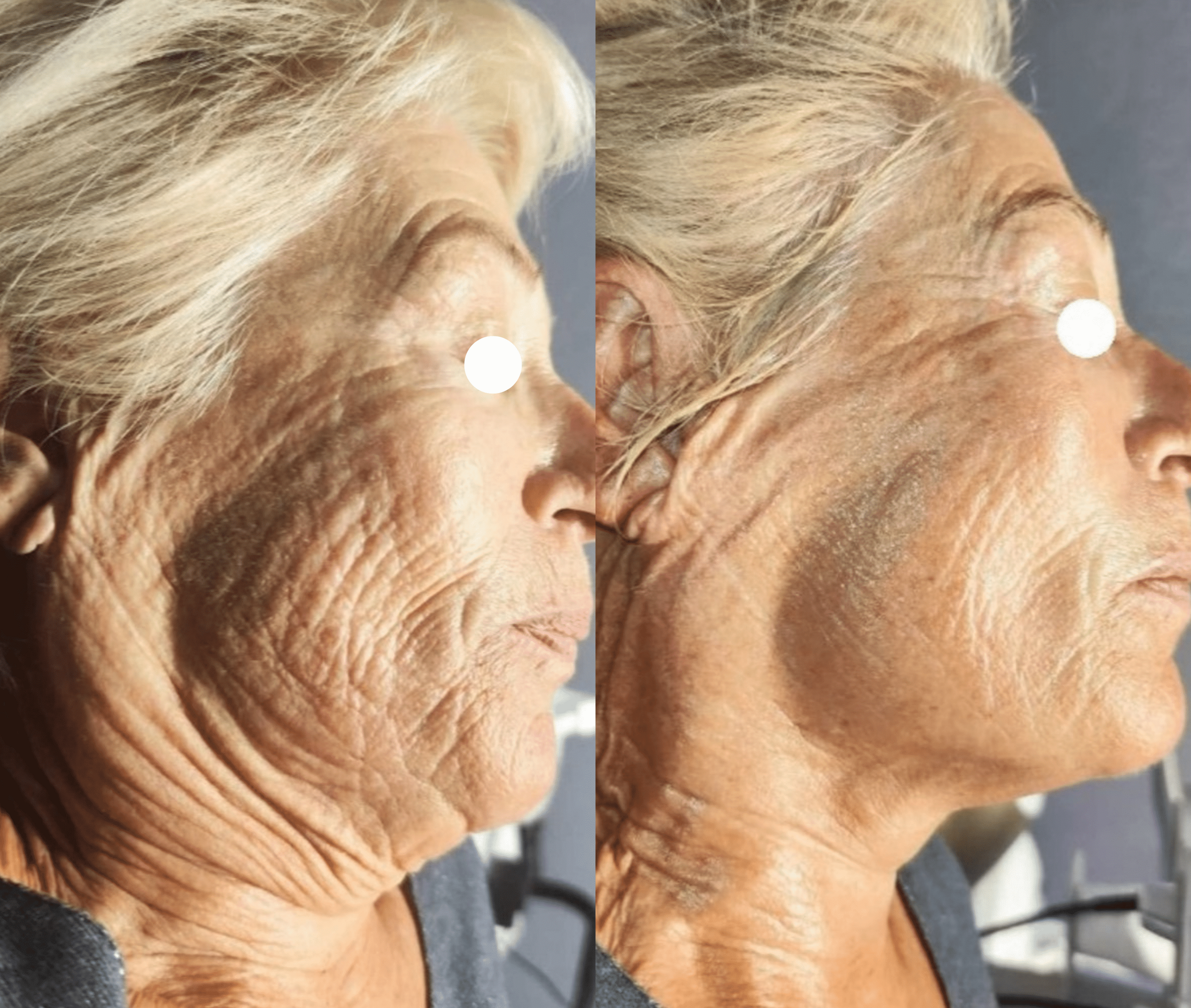 neocare advanced anti age 4 seances