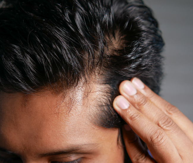 Diagnostic capillaire perte de cheveux