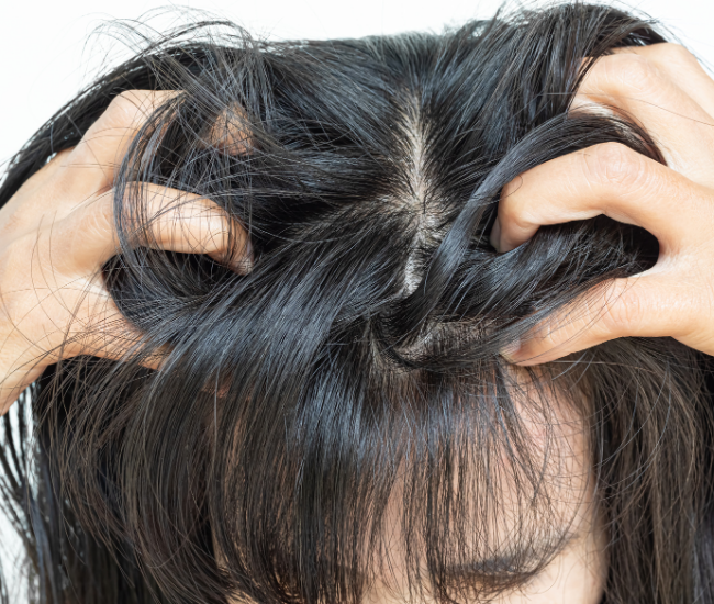 cuir chevelu perte de cheveux alopecie photobiomodulation