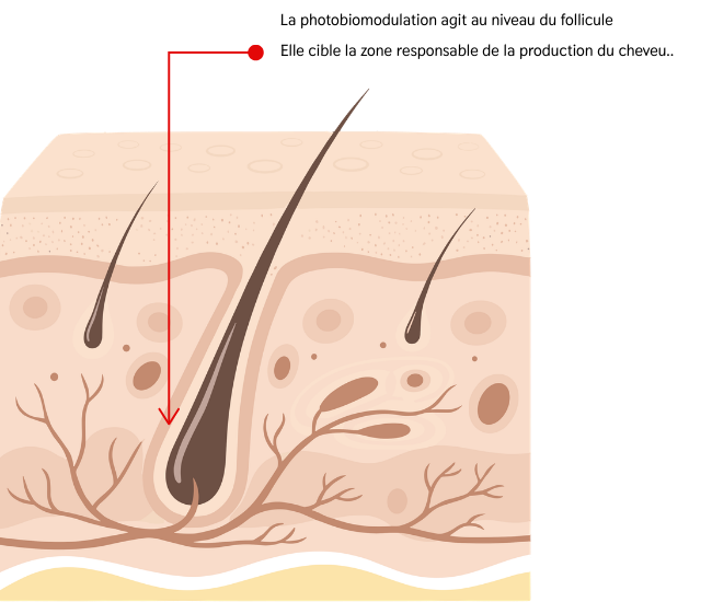 alopecie implants capillaire perte de cheveux lille 650 x 550 px 1