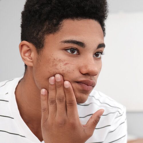 giant blackheads what is a dilated pore of winer
