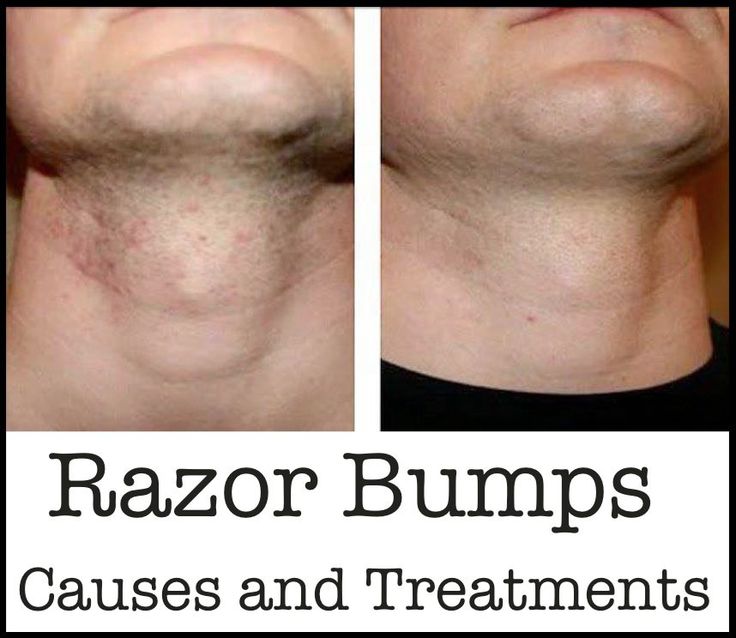 ARLOS RAZOR BUMPS 1