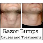 ARLOS RAZOR BUMPS 1