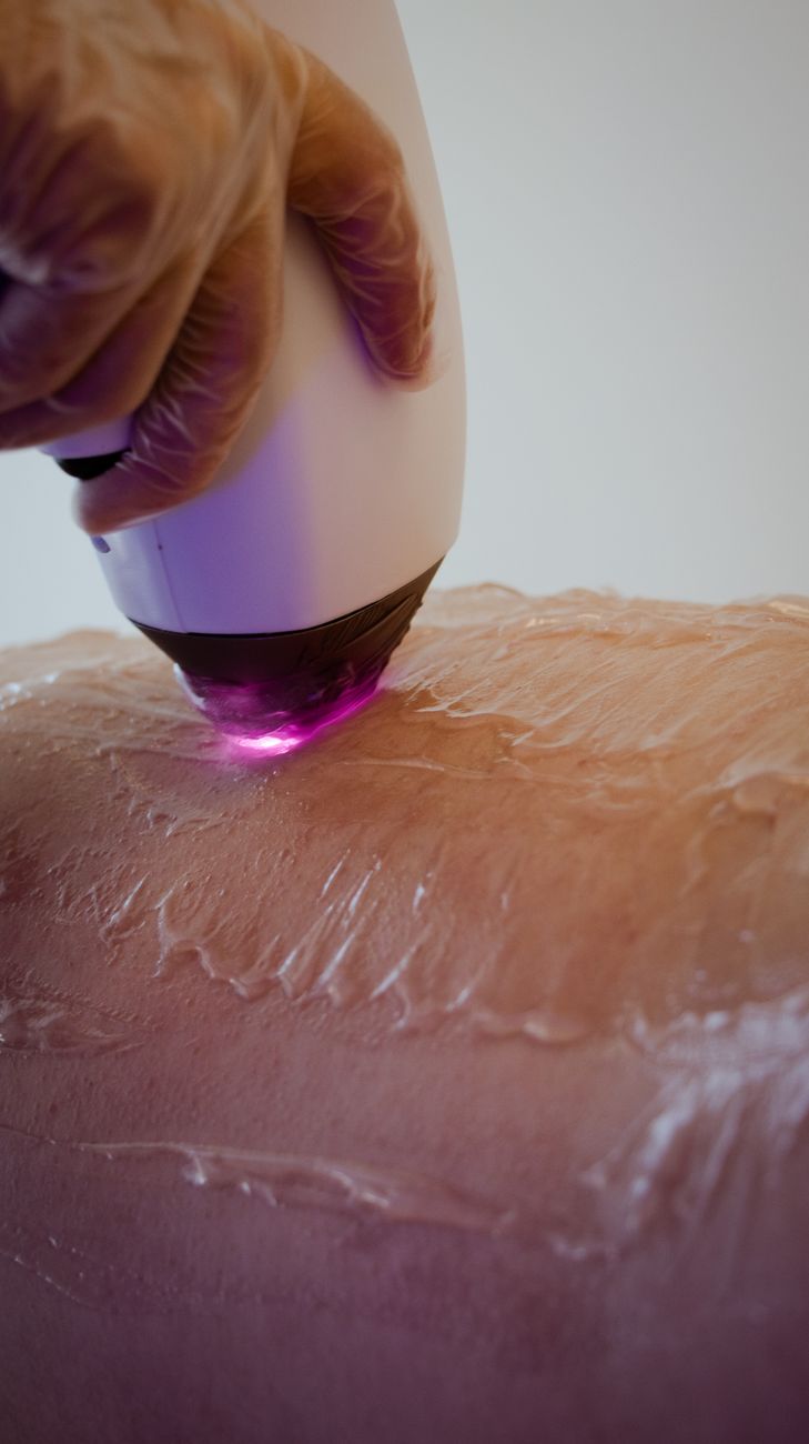 gros plan sur un traitement de soin de la peau au laser sur la peau avec une main visible tenant le dispositif
