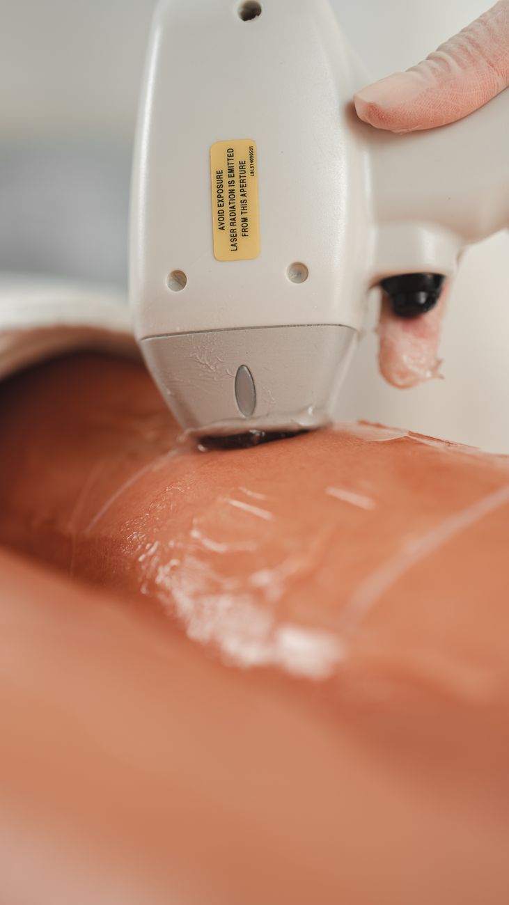 gros plan sur une procedure d epilation laser realisee sur une peau avec application de gel rafraichissant
