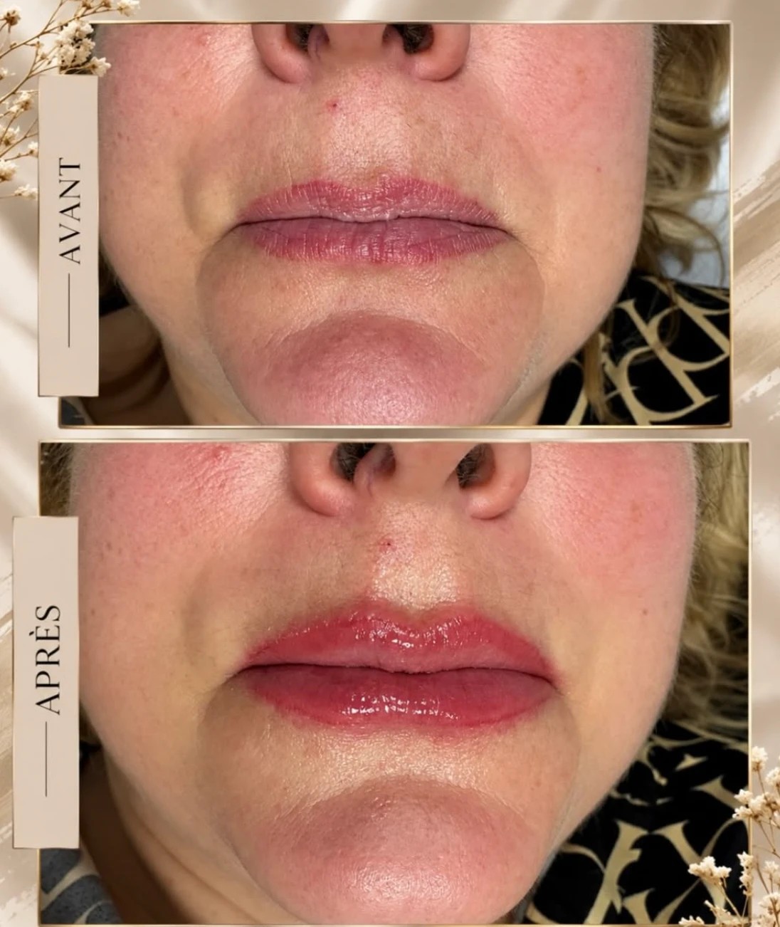 Avant / après d'une pigmentation des lèvres candy lips