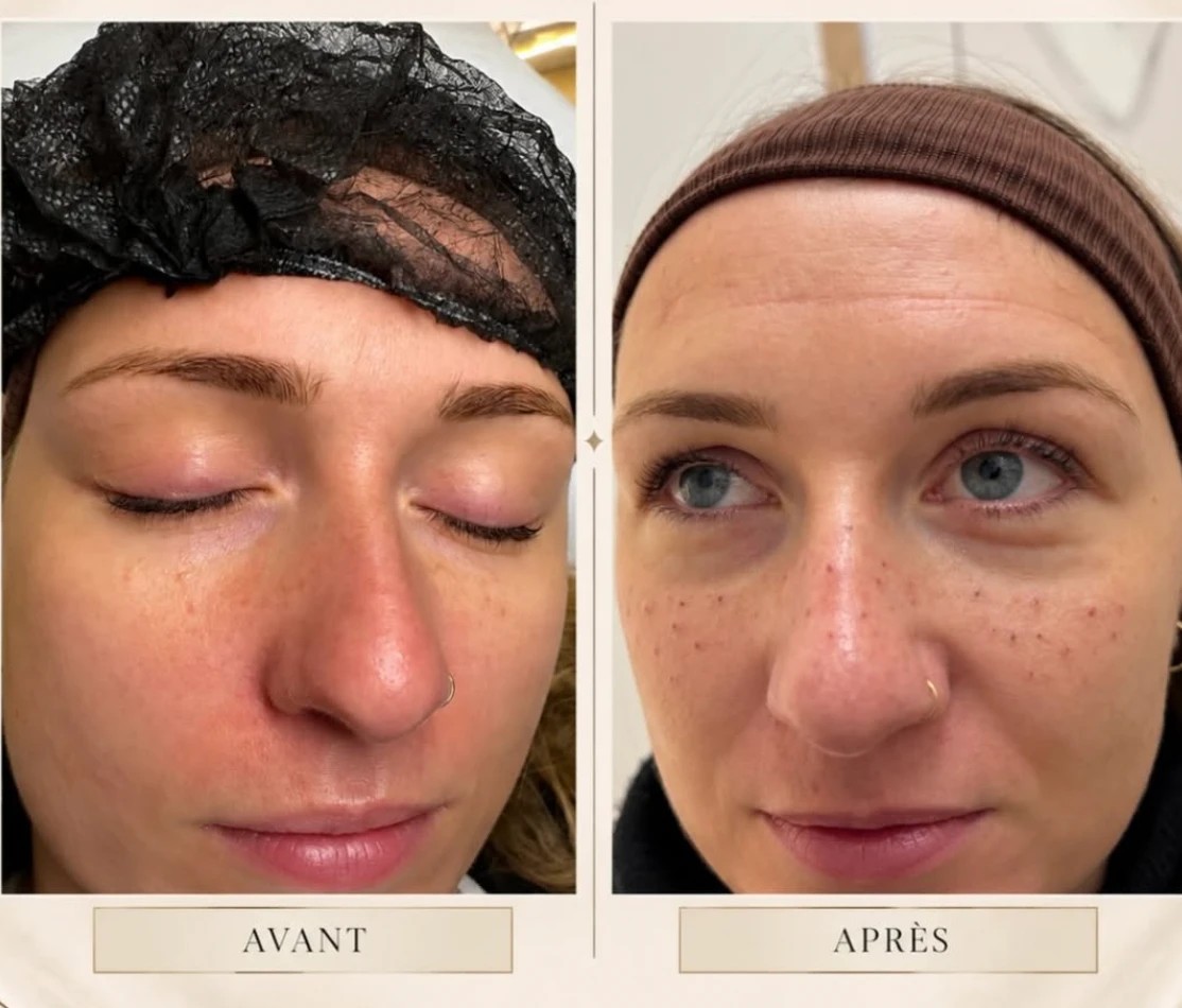 Avant / après de taches de rousseur pigmentées effet naturel